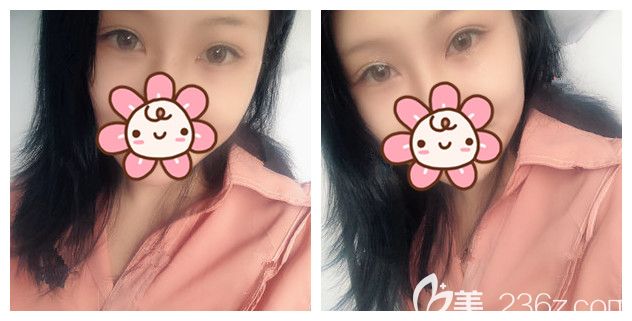 眼綜合修復(fù)術(shù)后27天恢復(fù)情況