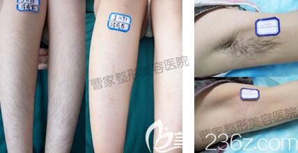 ？邵陽曹家整形冰點脫毛真人前后對比照