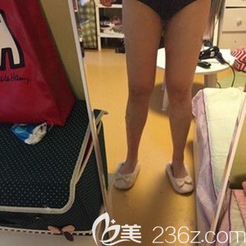 在韓國35mc做吸脂手術(shù)后40天 在韓國35mc做吸脂手術(shù)后40天