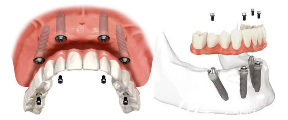 all-on-4種植牙原理示意圖片 all-on-4種植牙原理示意圖片