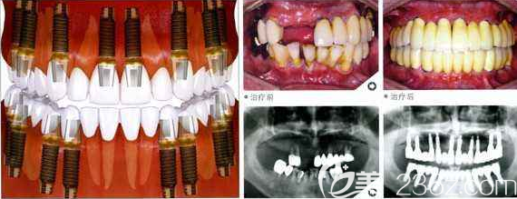 全口傳統(tǒng)種植牙前后效果對(duì)比示意圖 全口傳統(tǒng)種植牙前后效果對(duì)比示意圖