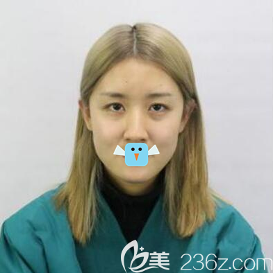 成美羅榮懷全臉自體脂肪填充術(shù)前照 成美羅榮懷全臉自體脂肪填充術(shù)前照