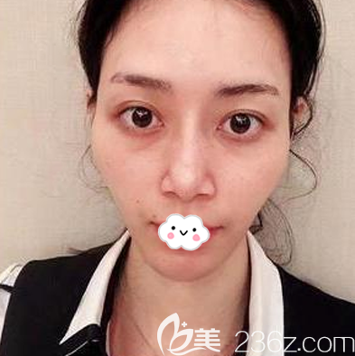 在廣州星團醫(yī)美做脂肪填充術(shù)前照片 在廣州星團醫(yī)美做脂肪填充術(shù)前照片