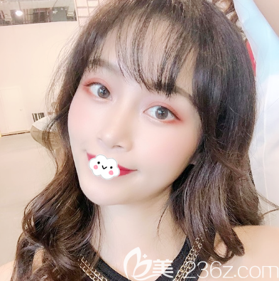 廣州星團醫(yī)美脂肪填充全臉一個月效果圖 廣州星團醫(yī)美脂肪填充全臉一個月效果圖