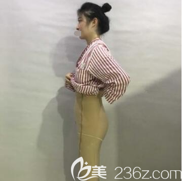 大腿抽脂手術(shù)后即刻照片