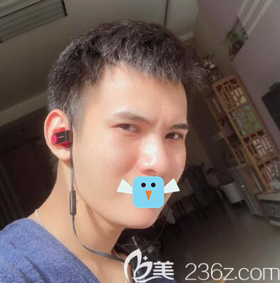 成都成美賴(lài)明忠給我做了硅膠墊下巴手術(shù)3個(gè)月后，臉型有了明顯改善我現(xiàn)在也是型男了