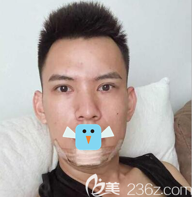 賴明忠假體墊下巴術(shù)后5天