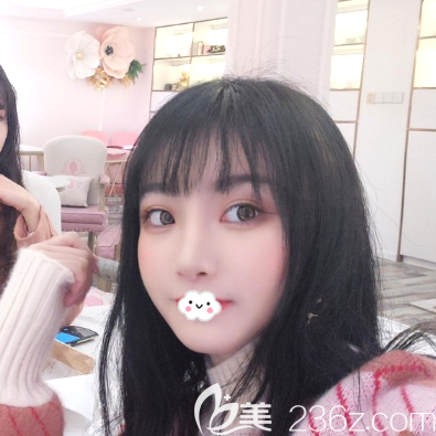 雙眼皮隆鼻術(shù)后15天恢復(fù)效果圖 雙眼皮隆鼻術(shù)后15天恢復(fù)效果圖