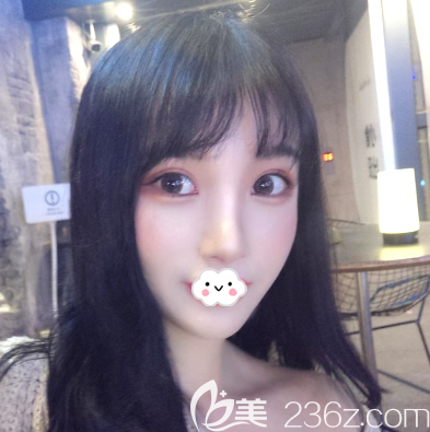 深圳潤(rùn)澤瑞尼絲雙眼皮隆鼻案例一個(gè)月效果圖 深圳潤(rùn)澤瑞尼絲雙眼皮隆鼻案例一個(gè)月效果圖