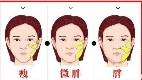 面部吸脂適合什么人
