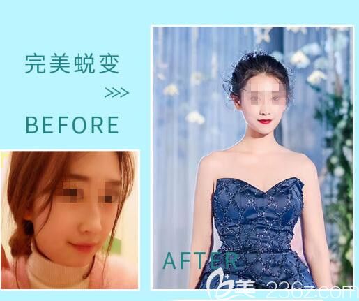 鄭州菲林面部吸脂案例