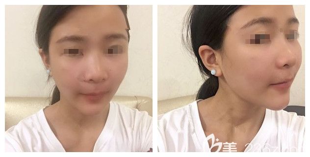 剛做完愛芙萊玻尿酸豐下巴術(shù)后