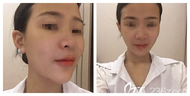 術(shù)后一周玻尿酸豐下巴效果