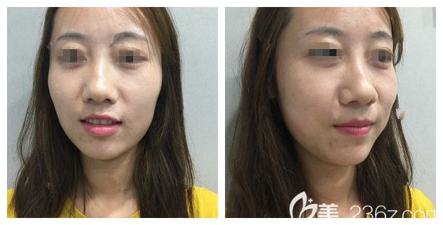 面診南京藝星術前面部凹陷大鼻頭 面診南京藝星術前面部凹陷大鼻頭