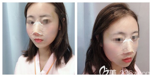 剛做完自體脂肪填充+硅膠隆鼻術后即刻 剛做完自體脂肪填充+硅膠隆鼻術后即刻