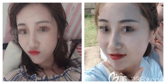 做完面部脂肪填充+隆鼻縮鼻頭術后半個月恢復 做完面部脂肪填充+隆鼻縮鼻頭術后半個月恢復