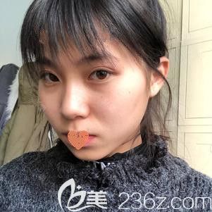 在張家口天宏注射瘦臉后面部微腫