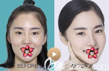 臺(tái)州藝星王波做鼻綜合隆鼻案例