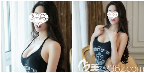 因?yàn)樾匦”荒信笥严訔?所以我去深圳潤澤瑞尼絲找劉庚做了自體脂肪隆胸,摸起來手感很真實(shí)