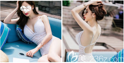 深圳潤(rùn)澤瑞尼絲劉庚自體脂肪隆胸案例 深圳潤(rùn)澤瑞尼絲劉庚自體脂肪隆胸案例