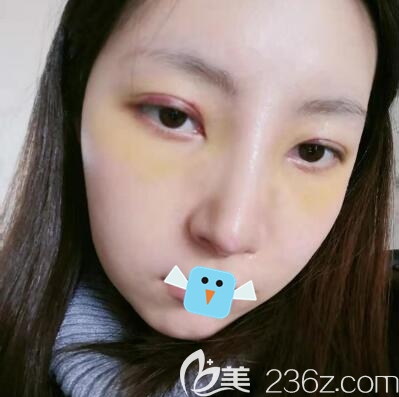 成都向朝肋軟骨隆鼻拆線后效果