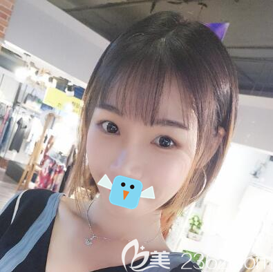 四川友誼醫(yī)院李繼華顴骨顴弓+下頜角整形術后效果圖