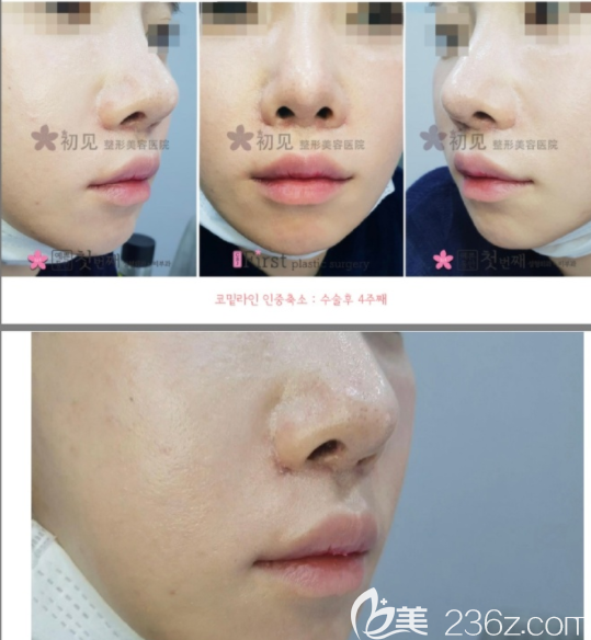 韓國(guó)初見(jiàn)first整形醫(yī)院人中縮短真人案例 韓國(guó)初見(jiàn)first整形醫(yī)院人中縮短真人案例