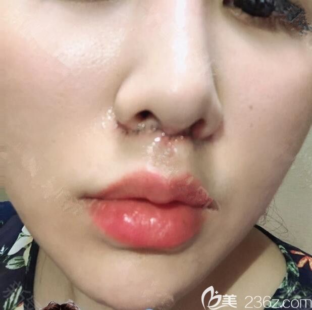 人中長太兇韓國初見first整形趙庸佑人中縮短讓我看起來和善年輕多了