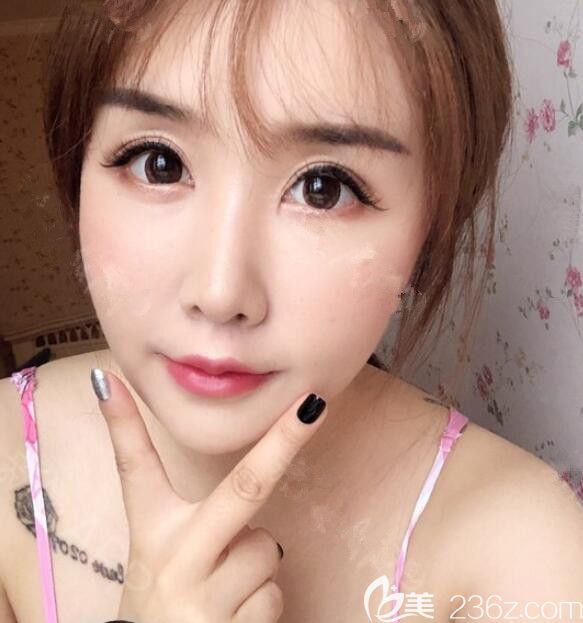 韓國(guó)初見(jiàn)first整形做人中縮短怎么樣 韓國(guó)初見(jiàn)first整形做人中縮短怎么樣