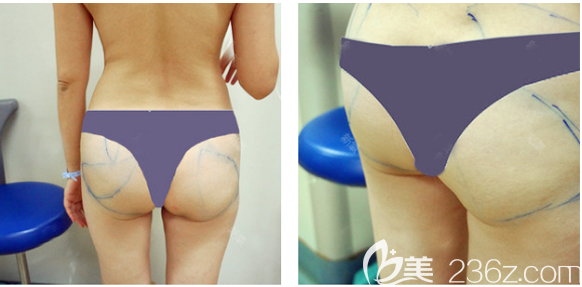 廣州荔醫(yī)整形美容門診部齊云香術(shù)前照片1