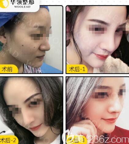 賀小虎醫(yī)生隆鼻案例展示