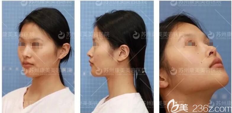 面診蘇州康美術(shù)前塌鼻子 面診蘇州康美術(shù)前塌鼻子