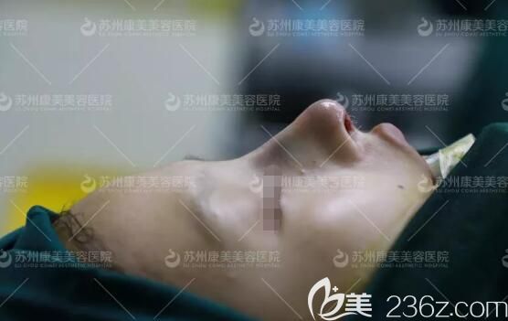 做完肋軟骨鼻綜合術(shù)后即刻效果 做完肋軟骨鼻綜合術(shù)后即刻效果