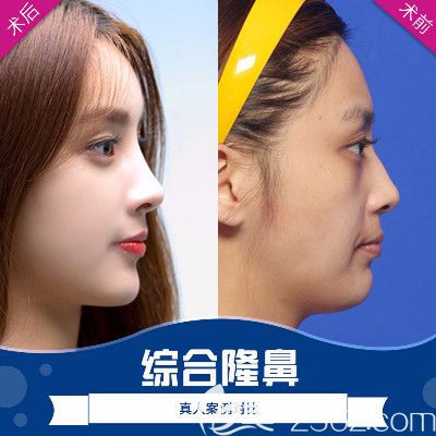 廣州荔醫(yī)整形醫(yī)院張勇做隆鼻怎么樣