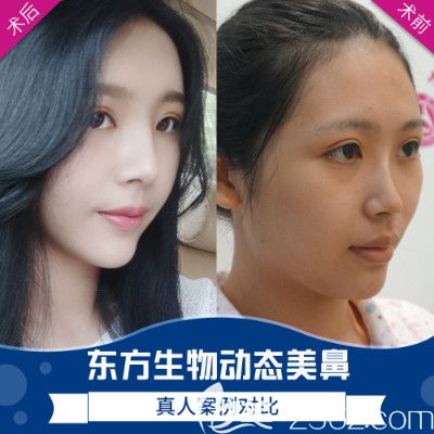 廣州荔醫(yī)張勇做的隆鼻失敗修復(fù)和肋軟骨隆鼻案例