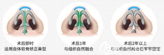 廣州荔醫(yī)張勇醫(yī)生拱形支架隆鼻技術(shù)