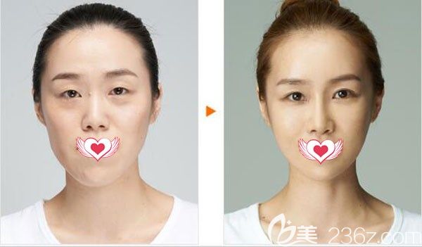 博美陳茂年做鼻綜合+硅膠隆鼻+下頜角+雙眼皮手術(shù)案例