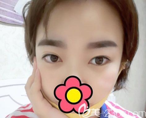 呼和浩特五洲女子醫(yī)院整形科王煥割雙眼皮前 呼和浩特五洲女子醫(yī)院整形科王煥割雙眼皮前