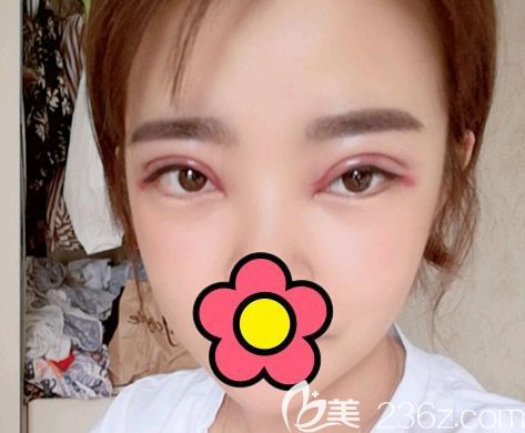 呼市五洲整形王煥全切雙眼皮7mm第1天圖片 呼市五洲整形王煥全切雙眼皮7mm第1天圖片