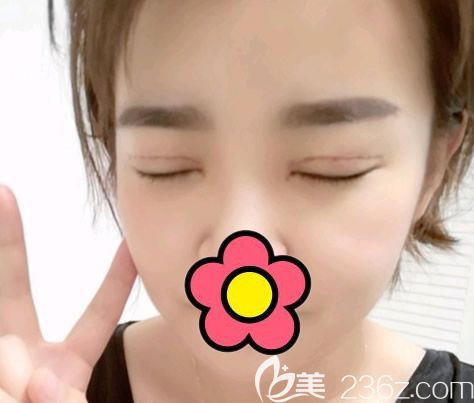 切開雙眼皮第5天的閉眼照 切開雙眼皮第5天的閉眼照