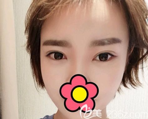 真人案例:呼和浩特五洲女子醫(yī)院整形科王煥給大家說說韓式定位雙眼皮和切開雙眼皮區(qū)別