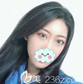 臺(tái)州藝星阮凱做雙眼皮案例 臺(tái)州藝星阮凱做雙眼皮案例