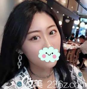 臺州也有yestar藝星整形了,這是我剛在臺州藝興做完雙眼皮和開眼角后眼睛效果,看看好不好看