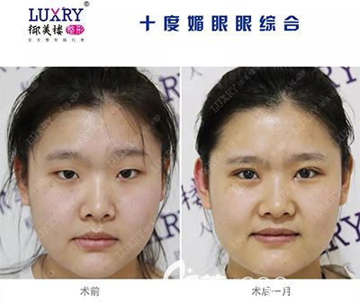 雞西御美樓雙眼皮效果對比