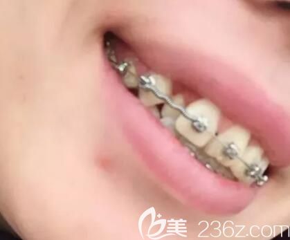 我在昆明德韓口腔戴牙套第4個(gè)月 我在昆明德韓口腔戴牙套第4個(gè)月