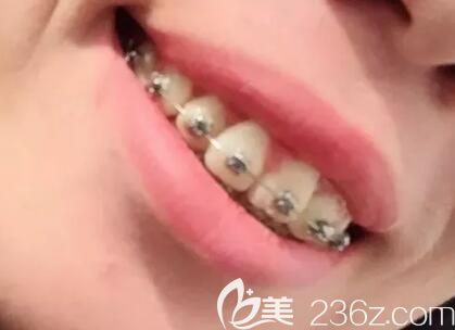 我在昆明德韓口腔做自鎖托槽矯正第6個(gè)月 我在昆明德韓口腔做自鎖托槽矯正第6個(gè)月