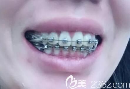 牙齒擁擠錯亂在昆明德韓口腔做金屬自鎖托槽牙齒矯正，戴牙套9個月開始收牙縫啦
