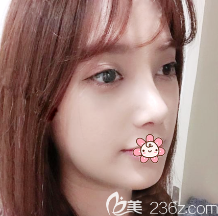 雙眼皮隆鼻術(shù)后10天效果圖 雙眼皮隆鼻術(shù)后10天效果圖