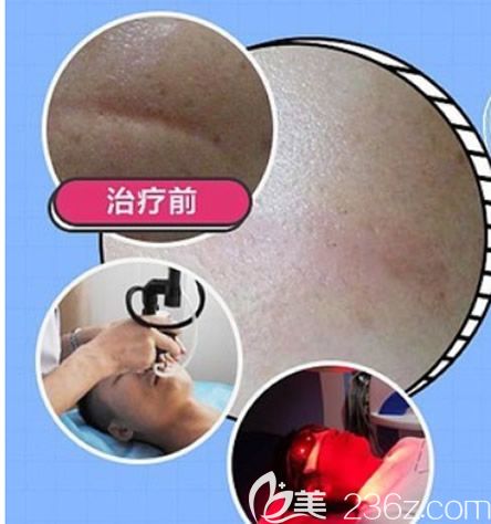 呼和浩特京美激光祛疤效果案例