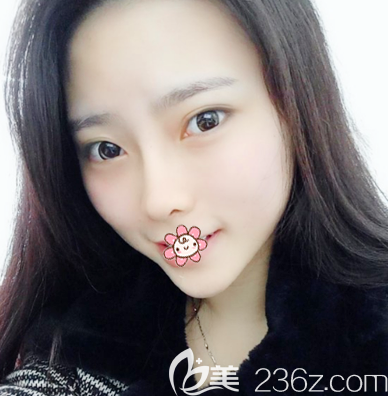 鄒順祿醫(yī)生鼻綜合隆鼻術(shù)后15天 鄒順祿醫(yī)生鼻綜合隆鼻術(shù)后15天